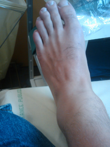 ankle1