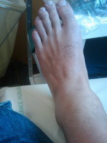 ankle1