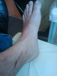 ankle2