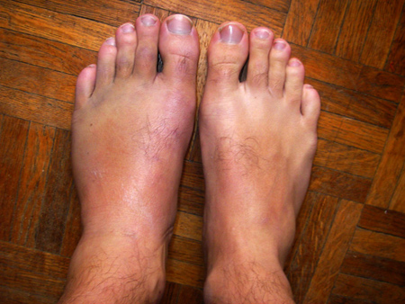 ankle3